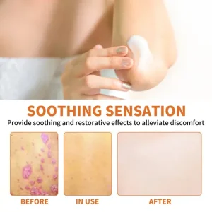 Cvreoz® Bee Venom Psoriasis Treatment Cream