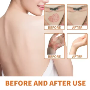 Cvreoz® Bee Venom Psoriasis Treatment Cream